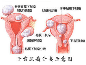 子宫肌瘤的症状