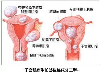 子宫肌瘤的形成原因