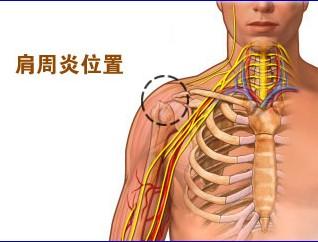 肩周炎的症状