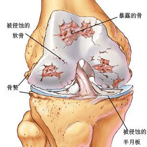 关节炎的症状