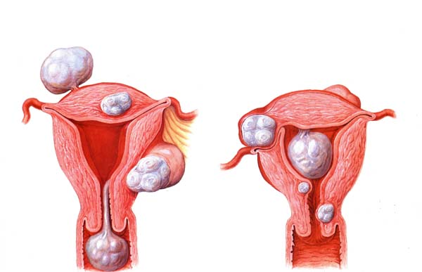 子宫肌瘤