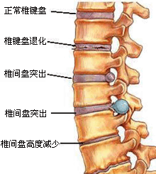 腰椎间盘突出的致病原因