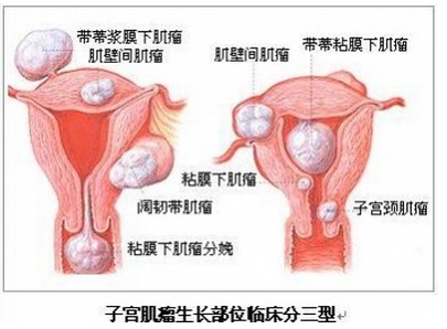 子宫肌瘤的症状