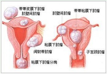 子宫肌瘤症状